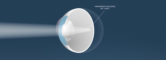 Astigmatismus, Augenärzte Linz, Dirisamer Luft Priglinger