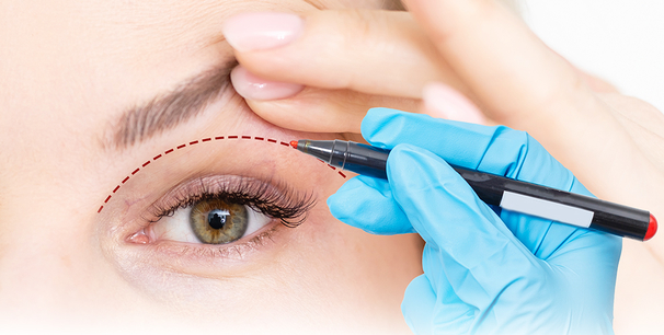 Augenlidstraffung, Augenarzt Linz und Wien, Dirisamer Luft Priglinger