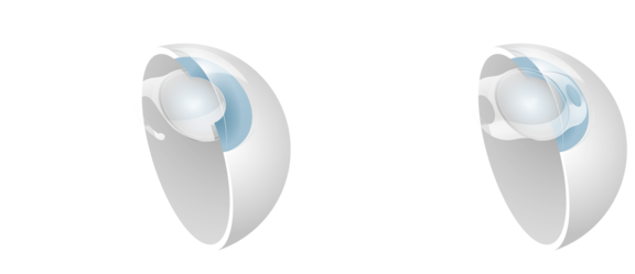 Intraokular-Linsen, Augenärzte Linz, Dirisamer Luft Priglinger