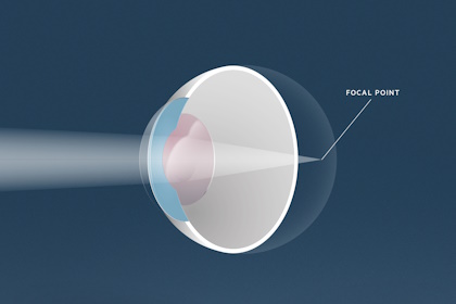 Alterssichtigkeit, Augenärzte Linz, Dirisamer Luft Priglinger