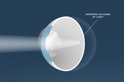 Astigmatismus, Augenärzte Linz, Dirisamer Luft Priglinger