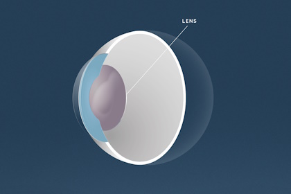 Grauer Star, Augenärzte Linz, Dirisamer Luft Priglinger