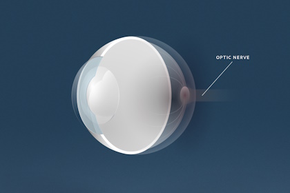 Grüner Star, Augenärzte Linz, Dirisamer Luft Priglinger
