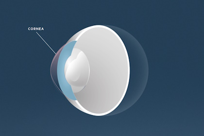 Keratokonus, Augenärzte Linz, Dirisamer Luft Priglinger