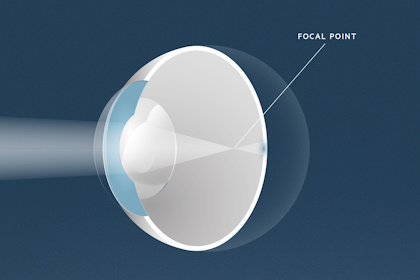 Kurzsichtigkeit, Augenärzte Linz, Dirisamer Luft Priglinger