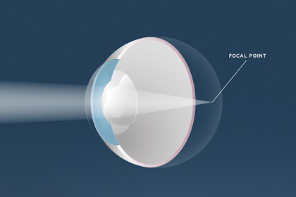 Weitsichtigkeit, Augenärzte Linz, Dirisamer Luft Priglinger