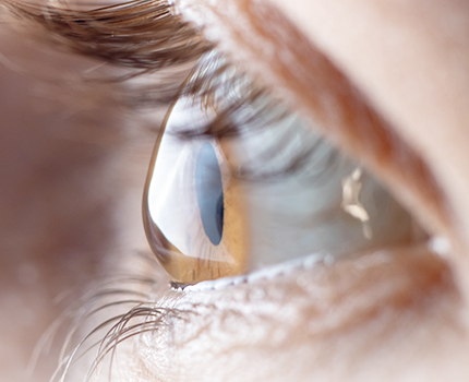 Hornhaut-Erkrankungen, Augenarzt Linz und Wien, Dirisamer Luft Priglinger